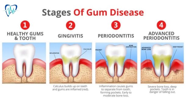 Can you explain the different stages of gum disease?