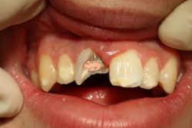 Broken or Chipped Teeth Dental Check-up Dental Check-up near me i Dental Check-up