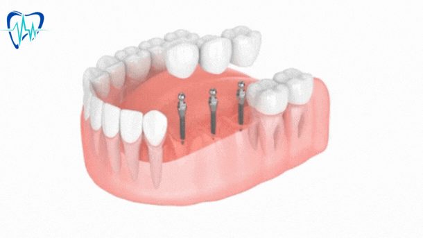 Dental Bridge Types | Benefits of Dental Bridges | What is a Dental Bridge?