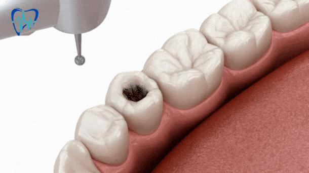 What are dental fillings? | filling procedure