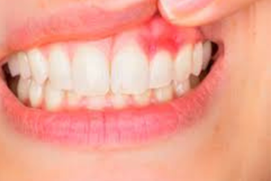 Gum Problems Teeth Cleaning Teeth Cleaning Cost Dental Check-up near me in Delhi