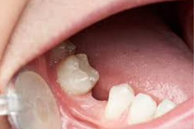 Tooth Loss Dental Check-up near me in Delhi Dental Check-up near me